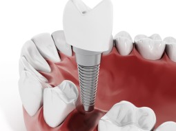 Как выбрать хорошие импланты для зубов