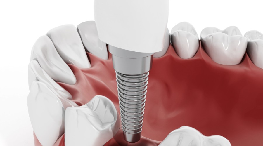 Как выбрать хорошие импланты для зубов